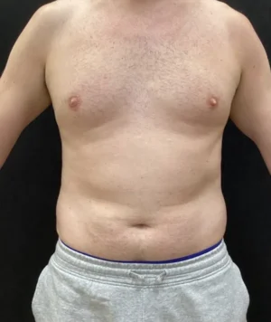 Liposuction for Men