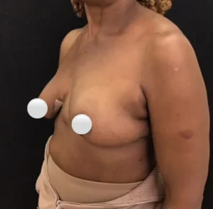 Breast Reduction