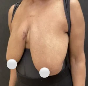 Breast Reduction