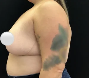 Breast Reduction