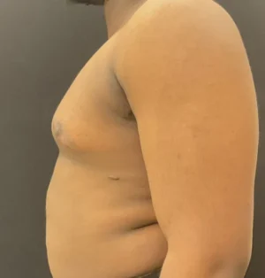 Gynecomastia