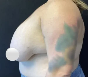 Breast Reduction
