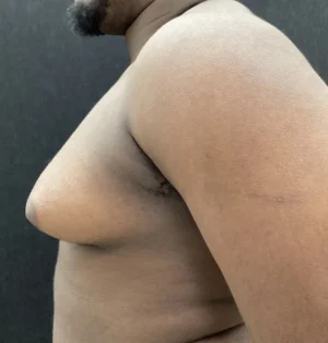 Gynecomastia