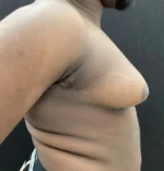 Gynecomastia