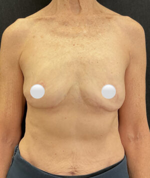 Breast Implant Removal