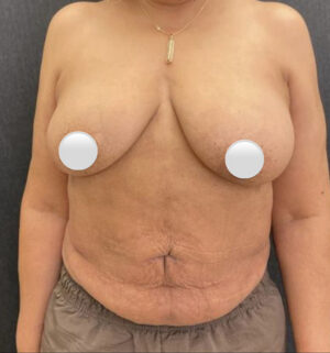 Liposuction
