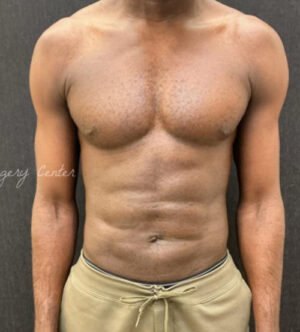 Liposuction for Men