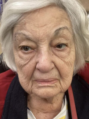 Facial Reconstruction