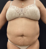 Liposuction