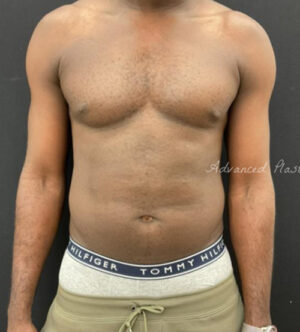 Liposuction for Men