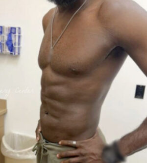 Liposuction for Men