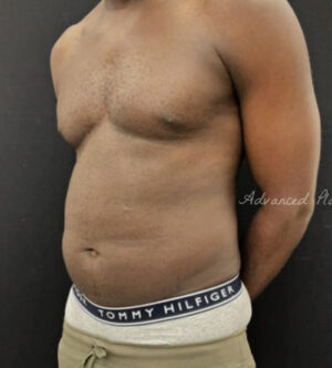 Liposuction for Men