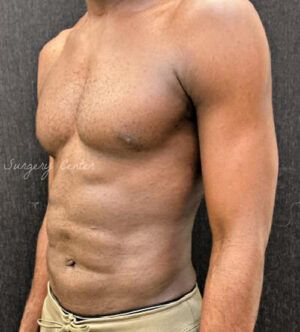 Liposuction for Men
