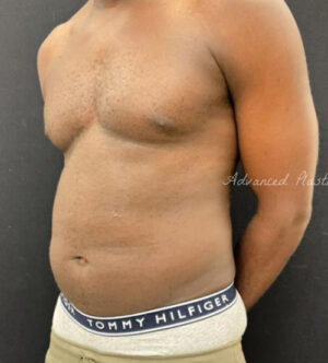Liposuction for Men