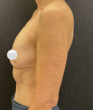 Breast Implant Removal