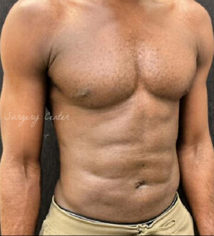 Liposuction for Men