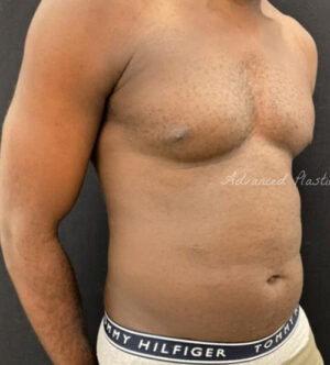 Liposuction for Men