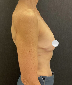 Breast Implant Removal