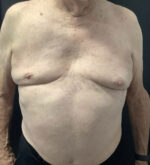 Gynecomastia