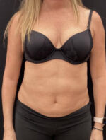 Liposuction