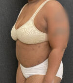 Liposuction