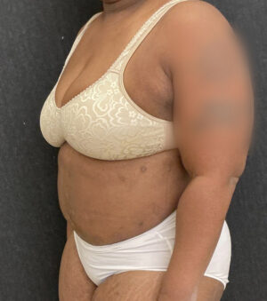 Liposuction