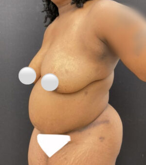 Liposuction