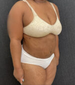 Liposuction