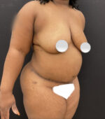 Liposuction