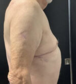 Gynecomastia