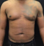 Liposuction for Men