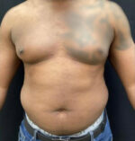 Liposuction for Men
