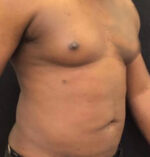 Liposuction for Men