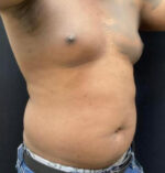 Liposuction for Men