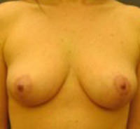 Breast Lift Before & After Results