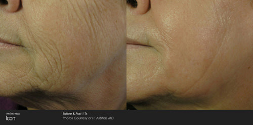 Skin Resurfacing