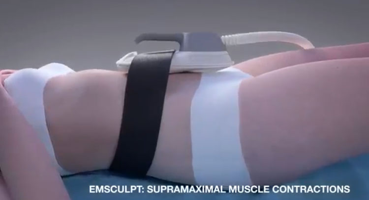 EM SCULPT - supramaximal muscle contractions