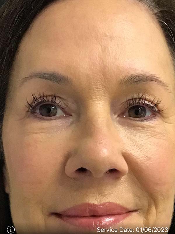 Blepharoplasty Result Newark