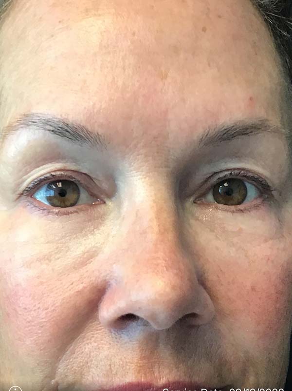 Blepharoplasty Result Newark